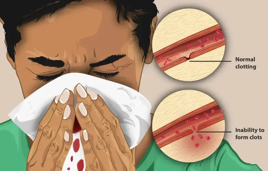 Human affected by Hemophilia, Source : Wikipedia