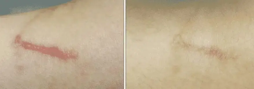 Comparison of keloid and hypertrophic scar