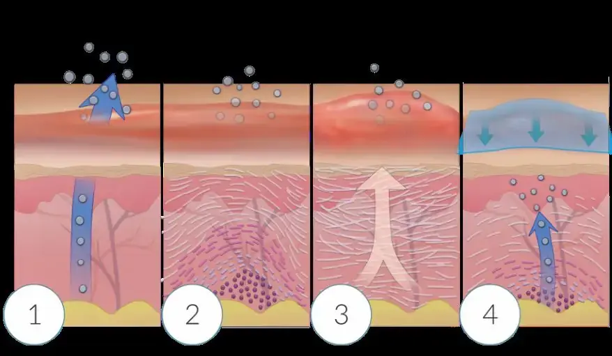 Diagram showing stages of scar formation, explaining why some wounds heal better than others.