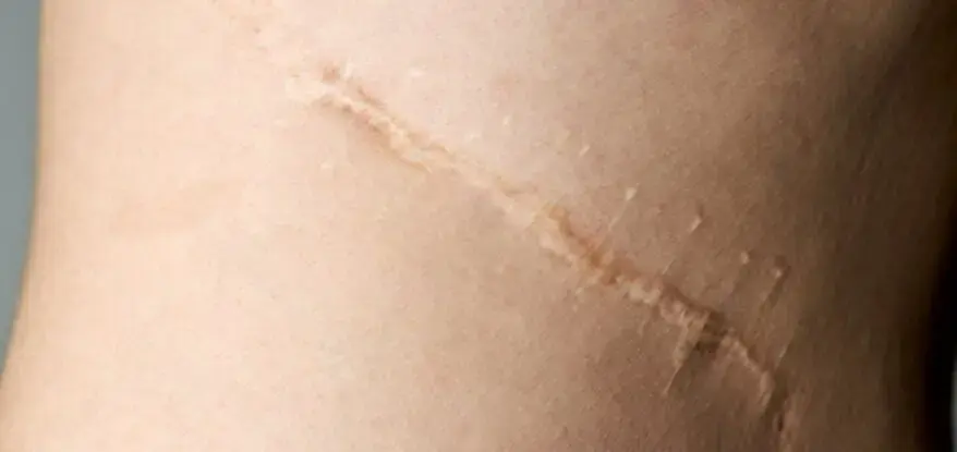 Image of a scar on skin, showing why some wounds heal better than others
